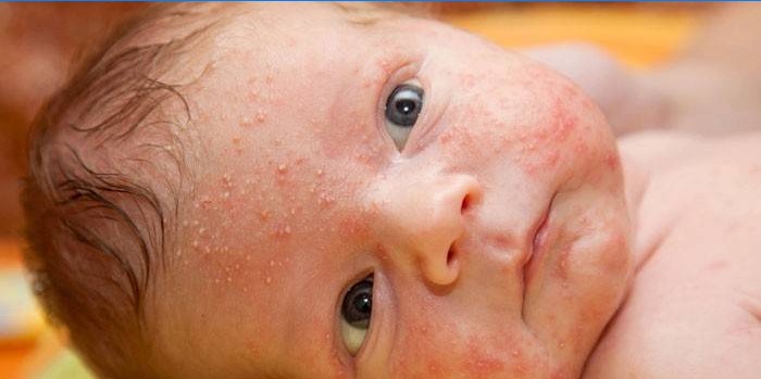 Hormonellt utslag i en baby i ansiktet