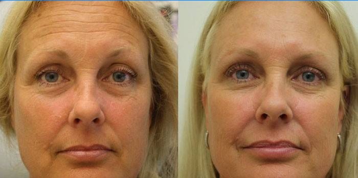 Kvinnans ansikte före och efter SMAS-lyft