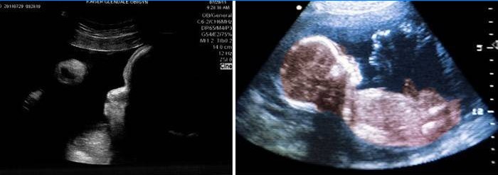 Ultraljud i buken vid 39 veckors graviditet