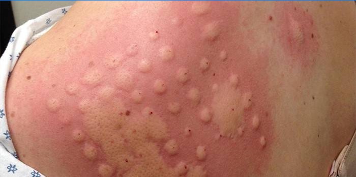 Allergiskt hudtest