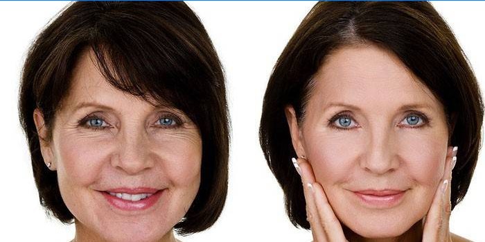 Kvinna före och efter botox för ansikte.