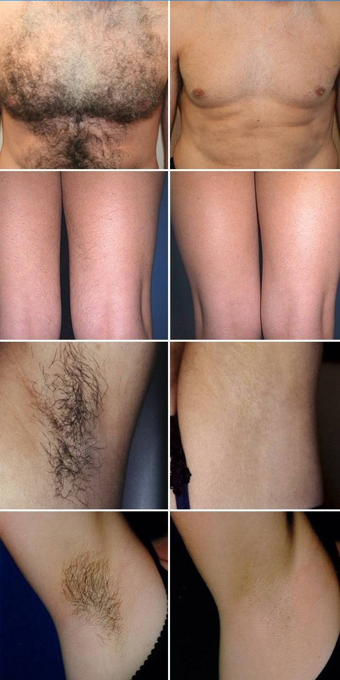 Foton före och efter Elos hårborttagning