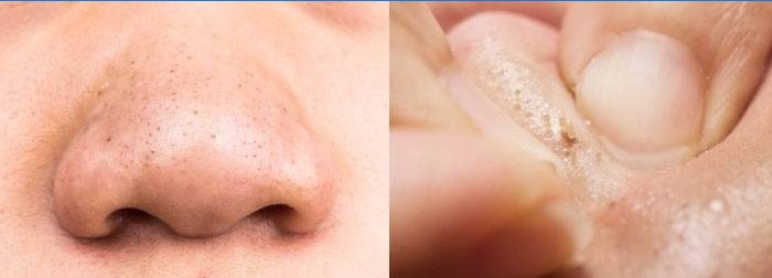 Hur komedoner ser ut på näsan