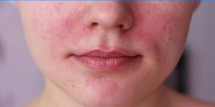Manifestationen av en allergi i ansiktet