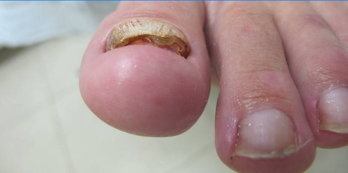 Påverkad toenail