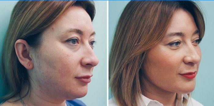 Kvinna före och efter lipolytiska injektioner