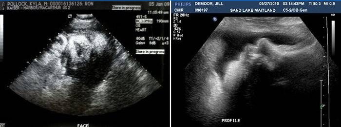 Ultraljud vid 38 veckors graviditet
