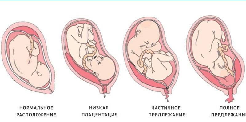 Typer av placenta previa